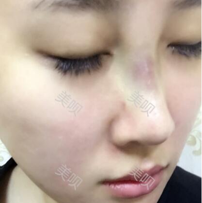 膨體隆鼻+墊鼻尖一個(gè)月時(shí)間的恢復(fù)過(guò)程