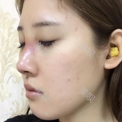 膨體隆鼻+墊鼻尖一個(gè)月時(shí)間的恢復(fù)過(guò)程