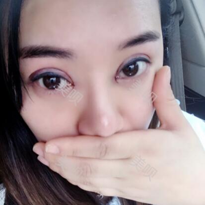 埋線雙眼皮我從內(nèi)雙的小眼睛變成大眼睛電眼了