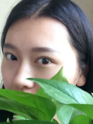 雙眼皮失敗修復(fù)手術(shù)恢復(fù)超自然，看起來一點都不假