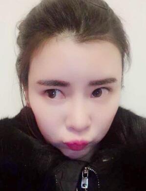 自體脂肪填充太陽穴