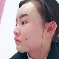 自體脂肪面部填充恢復(fù)過(guò)程分享，填充價(jià)格12000元