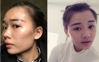 自體脂肪填充全臉整形前后對(duì)比圖