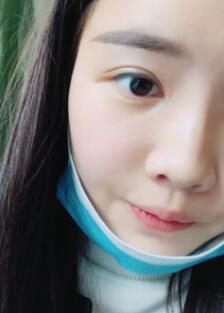 自體脂肪面部填充恢復(fù)一個(gè)月