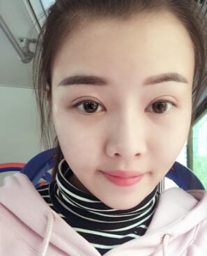 這就是我對(duì)自體脂肪面部填充恢復(fù)過(guò)程的簡(jiǎn)單分享