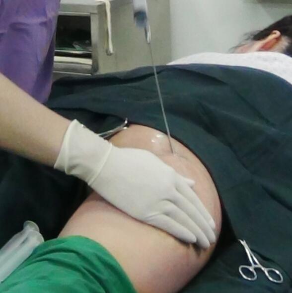 自體脂肪面部填充后我不再依賴p圖軟件了