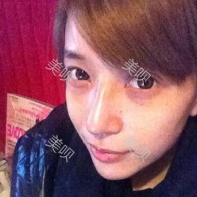 我的自體脂肪隆鼻+墊下巴恢復(fù)過程