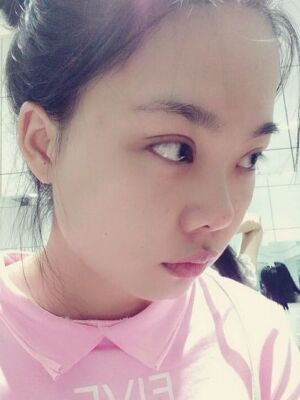 全切雙眼皮手術(shù)，送給自己的成年禮物