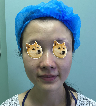 剛做了水光補(bǔ)水注射美容，分享一下手術(shù)過程的照片吧~~