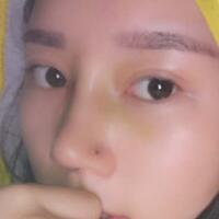 鼻子整形價(jià)格10000元，隆鼻手術(shù)過程圖分享