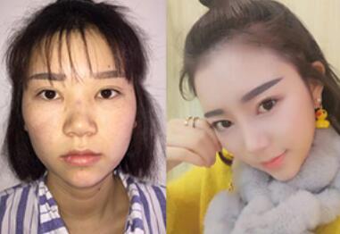 隆鼻整形前后對比圖