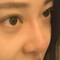 為什么大家覺得隆鼻恐怖，我就做了玻尿酸隆鼻，過程經(jīng)歷分享