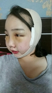 顴骨整形手術(shù)后，我也可以擁有精致小臉了