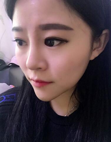 玻尿酸隆鼻恢復(fù)過(guò)程圖