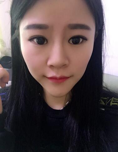 玻尿酸隆鼻恢復(fù)過(guò)程圖