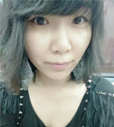 紅藍(lán)光祛痘手術(shù)恢復(fù)過程分享，還有前后對(duì)比果圖片哦~