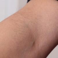 從小我就毛發(fā)旺盛，做了激光脫毛果圖分享給大家