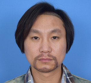 種植胡須手術(shù)前后過(guò)程以及對(duì)比照片分享