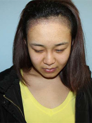 做了發(fā)際線種植手術(shù)，感覺(jué)還不錯(cuò)!