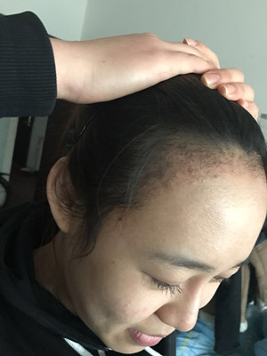 做了發(fā)際線種植手術(shù)，感覺(jué)還不錯(cuò)!