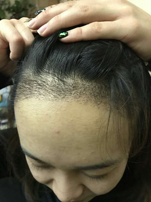 做了發(fā)際線種植手術(shù)，感覺(jué)還不錯(cuò)!