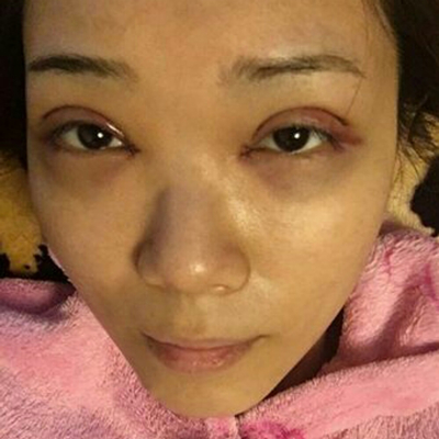 開內(nèi)眼角+切開割雙眼皮兩個月了，分享術(shù)后恢復過程照片~