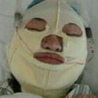 做了磨下頜角手術(shù)一年了，手術(shù)費用為16800元，已經(jīng)完全恢復(fù)