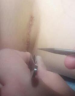 假體隆胸恢復(fù)一周,拆線了