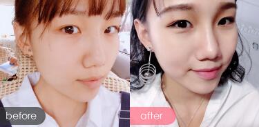 玻尿酸隆鼻前后對比圖