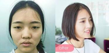 整形前后對(duì)比圖,左邊是微整形前