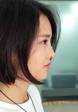 割雙眼皮+開(kāi)眼角+隆鼻整形