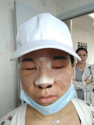 廣州廣美做的假體隆鼻，給大家分享一下手術(shù)前后過程以及對(duì)比照片