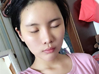 自體脂肪填充全臉，前后對(duì)比一下果棒棒噠!