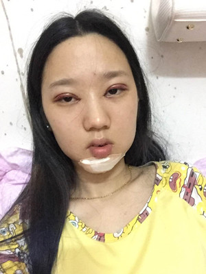 切開雙眼皮+假體隆下巴，我不再是典型的路人甲