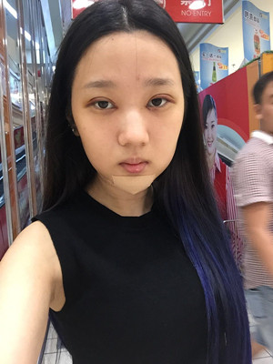 切開雙眼皮+假體隆下巴，我不再是典型的路人甲