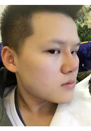 玻尿酸隆鼻+墊下巴親身經歷~~果不錯哦