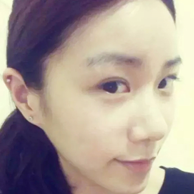 隆鼻整形+雙眼皮手術(shù)兩個月了，分享恢復(fù)前后對比果照片~