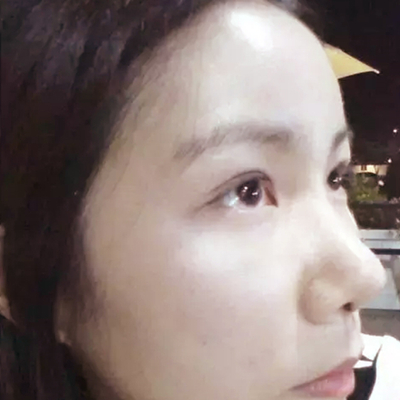 隆鼻整形+雙眼皮手術(shù)兩個月了，分享恢復(fù)前后對比果照片~