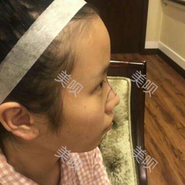 玻尿酸隆鼻前后對(duì)比照分享瞬間提升氣質(zhì)了哦