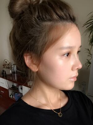 隆鼻和雙眼皮修復(fù)一起做的，現(xiàn)在氣質(zhì)提升好多