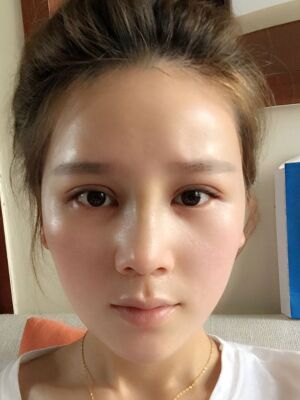 隆鼻和雙眼皮修復(fù)一起做的，現(xiàn)在氣質(zhì)提升好多