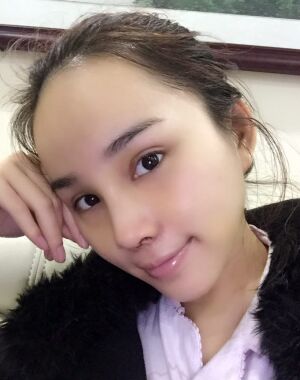 隆鼻整形+硅膠墊下巴前后對(duì)比照片給大家瞅瞅