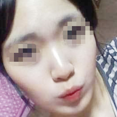 自體脂肪隆鼻術(shù)后一個月果分享，有前后對比照片喲~