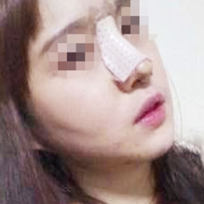 自體脂肪隆鼻術(shù)后一個月果分享，有前后對比照片喲~