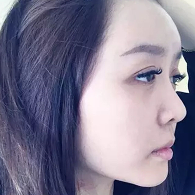 玻尿酸注射隆鼻、自體脂肪豐太陽穴跟玻尿酸墊下巴兩個月果照片~