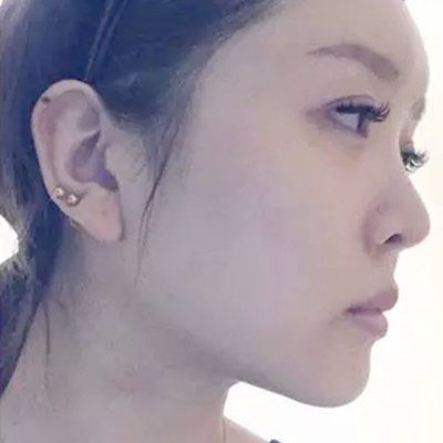 玻尿酸注射隆鼻、自體脂肪豐太陽穴跟玻尿酸墊下巴兩個月果照片~