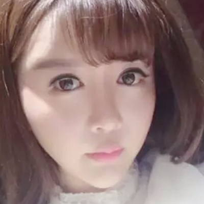 玻尿酸注射隆鼻、自體脂肪豐太陽穴跟玻尿酸墊下巴兩個月果照片~