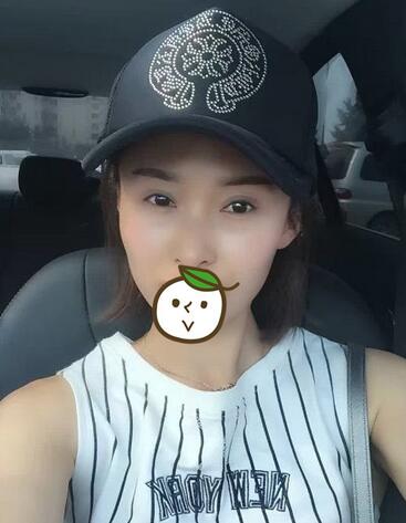 北京麗星雙眼皮修復半年了