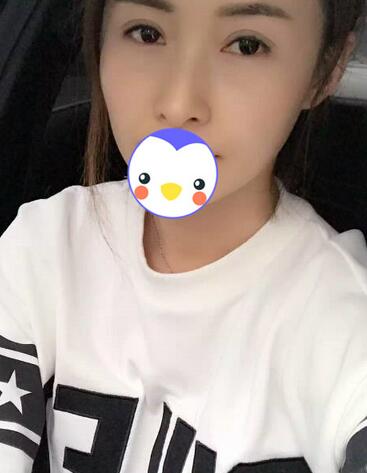 北京麗星雙眼皮修復半年了