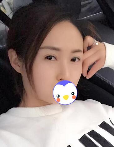 北京麗星雙眼皮修復半年了